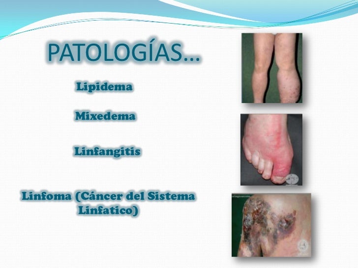 Sistema linfatico