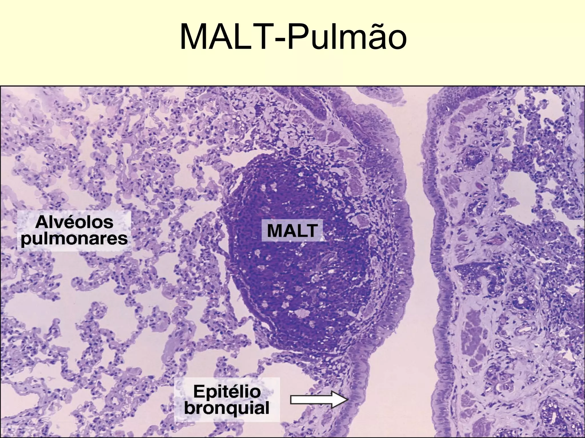 MALT-Pulmão 