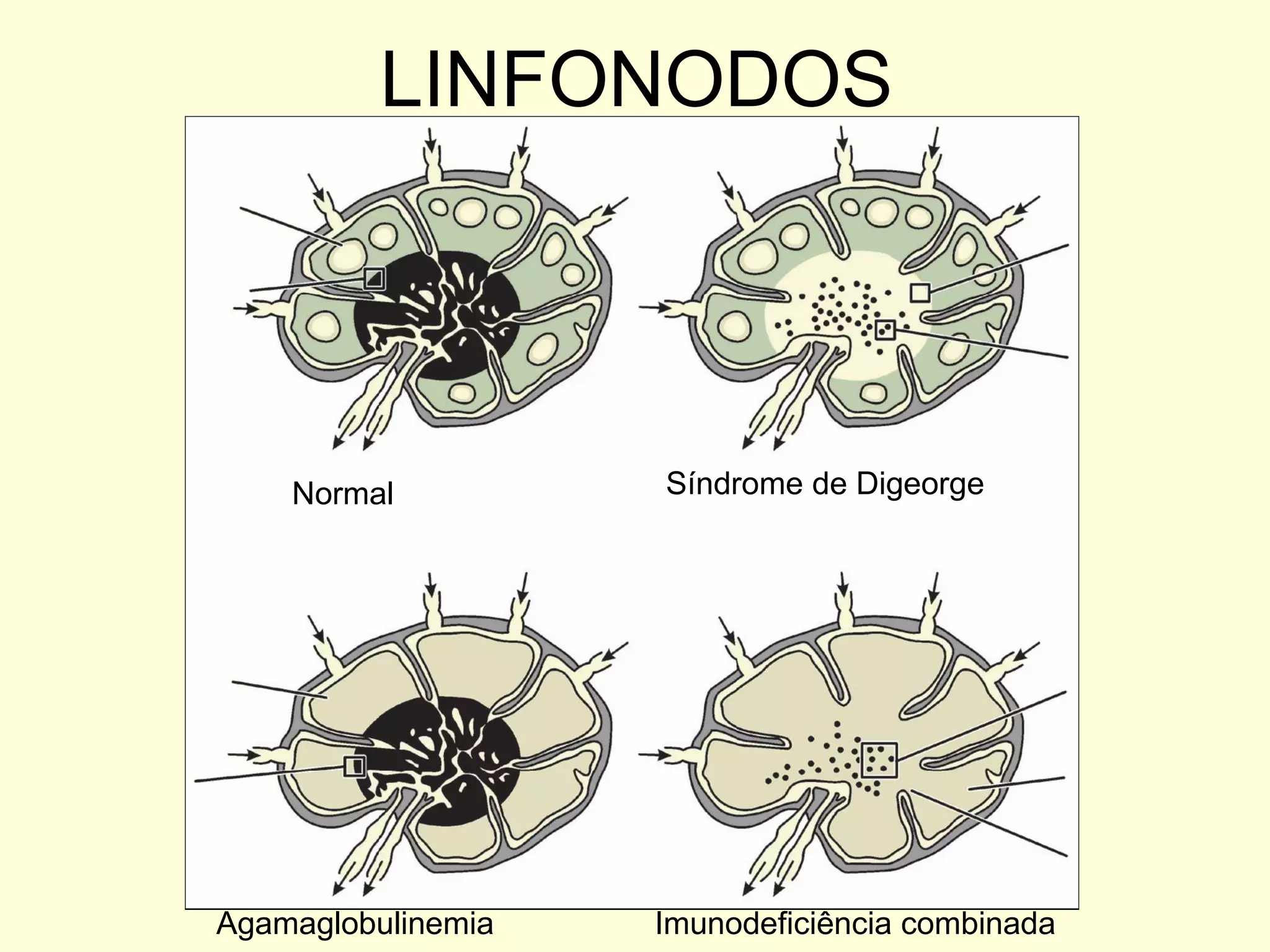 LINFONODOS Síndrome de Digeorge Agamaglobulinemia Imunodeficiência combinada Normal 