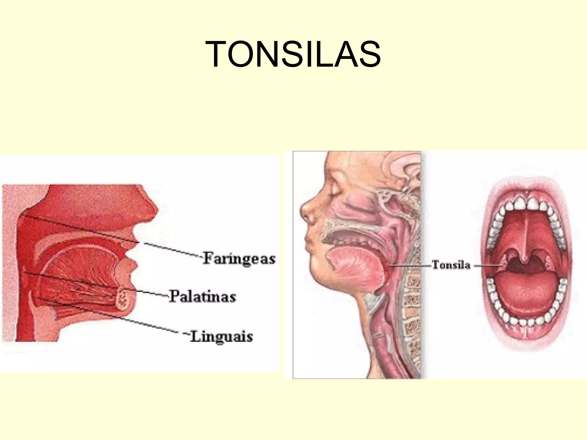 TONSILAS 