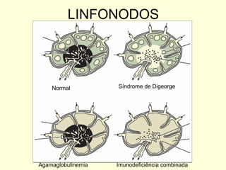 LINFONODOS Síndrome de Digeorge Agamaglobulinemia Imunodeficiência combinada Normal 