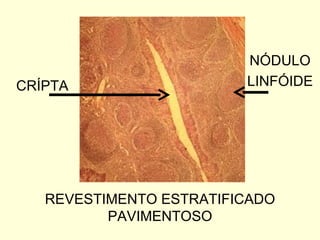 CRÍPTA REVESTIMENTO ESTRATIFICADO PAVIMENTOSO NÓDULO LINFÓIDE 