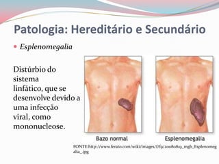 Patologia: Hereditário e Secundário
 Esplenomegalia


Distúrbio do
sistema
linfático, que se
desenvolve devido a
uma infecção
viral, como
mononucleose.

                   FONTE:http://www.ferato.com/wiki/images/f/f9/20080819_mgb_Esplenomeg
                   alia_.jpg
 