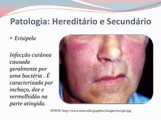 Patologia: Hereditário e Secundário
 Erisipela


Infecção cutânea
causada
geralmente por
uma bactéria . É
caracterizada por
inchaço, dor e
vermelhidão na
parte atingida.
                FONTE: http://www.umm.edu/graphics/images/es/2561.jpg
 