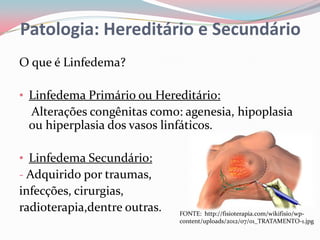 Patologia: Hereditário e Secundário
O que é Linfedema?

• Linfedema Primário ou Hereditário:
 Alterações congênitas como: agenesia, hipoplasia
 ou hiperplasia dos vasos linfáticos.

• Linfedema Secundário:
- Adquirido por traumas,
infecções, cirurgias,
radioterapia,dentre outras.   FONTE: http://fisioterapia.com/wikifisio/wp-
                              content/uploads/2012/07/01_TRATAMENTO-1.jpg
 