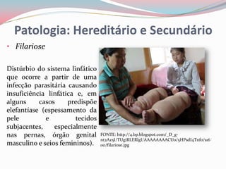Patologia: Hereditário e Secundário
• Filariose

Distúrbio do sistema linfático
que ocorre a partir de uma
infecção parasitária causando
insuficiência linfática e, em
alguns     casos     predispõe
elefantíase (espessamento da
pele         e          tecidos
subjacentes,    especialmente
nas pernas, órgão genital         FONTE: http://4.bp.blogspot.com/_D_g-
                                  nt2Az5I/TUgiRLERlgI/AAAAAAAACUo/5HPsdI4Tnf0/s16
masculino e seios femininos).     00/filariose.jpg
 