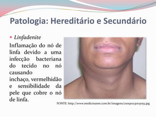 Patologia: Hereditário e Secundário
 Linfadenite
Inflamação do nó de
linfa devido a uma
infecção bacteriana
do tecido no nó
causando
inchaço, vermelhidão
e sensibilidade da
pele que cobre o nó
de linfa.
                  FONTE: http://www.medicinanet.com.br/imagens/20090123003055.jpg
 