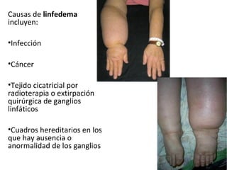 Causas de linfedema
incluyen:

•Infección

•Cáncer

•Tejido cicatricial por
radioterapia o extirpación
quirúrgica de ganglios
linfáticos

•Cuadros hereditarios en los
que hay ausencia o
anormalidad de los ganglios
                               9
 