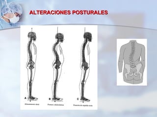 ALTERACIONES POSTURALES 
