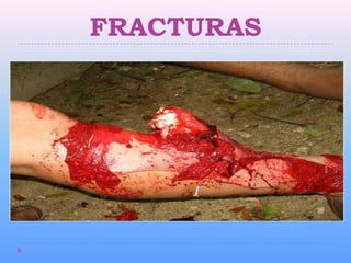 FRACTURAS
 