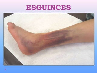 ESGUINCES
 