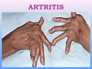 ARTRITIS
 