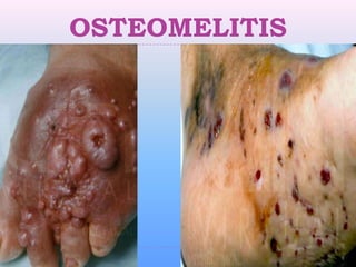 OSTEOMELITIS
 