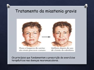 Tratamento da miastenia gravis

Os princípios que fundamentam a prescrição de exercícios
terapêuticos nas doenças neuromusculares.

 