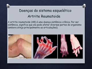 Doenças do sistema esquelético
Artrite Reumatoide
A artrite reumatoide (AR) é uma doença sistêmica crônica. Por ser
sistêmica, significa que ela pode afetar diversas partes do organismo
(embora atinja principalmente as articulações);

 