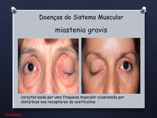 miastenia gravis

caracterizada por uma fraqueza muscular ocasionada por
distúrbios nos receptores de acetilcolina
Suwelane

 