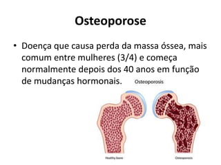 Osteoporose
• Doença que causa perda da massa óssea, mais
comum entre mulheres (3/4) e começa
normalmente depois dos 40 anos em função
de mudanças hormonais.
 