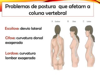 Problemas de postura que afetam a
coluna vertebral
Escoliose: desvio lateral
Cifose: curvatura dorsal
exagerada
Lordose: curvatura
lombar exagerada
 