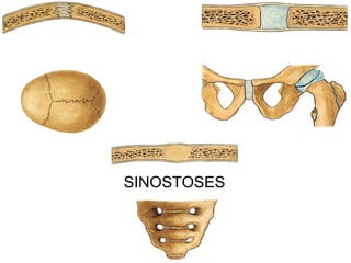 SINOSTOSES
 