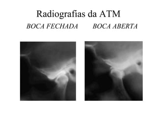Radiografias da ATM
BOCA FECHADA BOCA ABERTA
 
