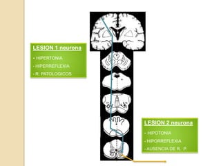 LESION 1 neurona
- HIPERTONIA
- HIPERREFLEXIA
- R. PATOLOGICOS




                   LESION 2 neurona
                   - HIPOTONIA
                   - HIPORREFLEXIA
                   - AUSENCIA DE R. P.
 
