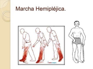 Marcha Hemipléjica.
 