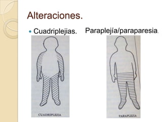 Alteraciones.
   Cuadriplejias.   Paraplejía/paraparesia.
 