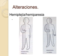 Alteraciones.
Hemiplejía/hemiparesia
 .
 