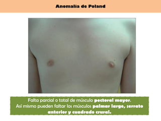 Anomalía de Poland




      Falta parcial o total de músculo pectoral mayor.
Así mismo pueden faltar los músculos palmar largo, serrato
               anterior y cuadrado crural.
 