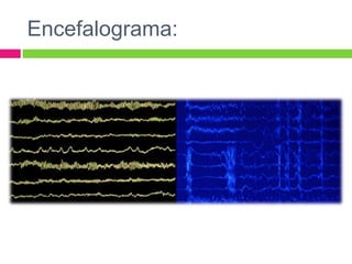Encefalograma:
 