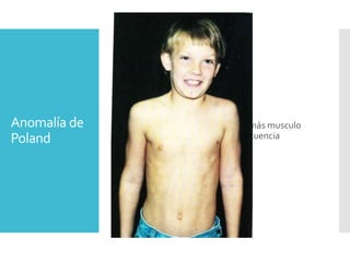 Anomalía de
Poland
Falta parcial o completa de uno o más musculo
pectoral. Se presenta con gran frecuencia
 