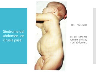 Síndrome del
abdomen en
ciruela pasa
 Ausencia parcial o total de los músculos
abdominales.
 Pared abdominal delgada.
 Acompañado con malformaciones del sistema
urinario y vejiga, como: la obstrucción uretral,
acumulación de líquido, distensión del abdomen.
 