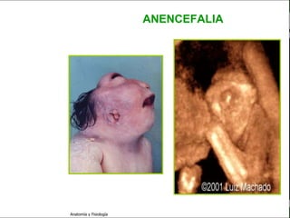 c
                                                               Sistema Nervioso

                                                 ANENCEFALIA


   Sistema Nervioso

           Histología

     Médula espinal

     Bulbo raquídeo

Protuberancia anular

            Cerebelo

       ´Mesencéfalo

          Diencéfalo

             Cerebro

      S. N. Periférico

     S. N. Autónomo


                         Anatomía y Fisiología                               7
 
