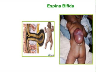 c
                                                                 Sistema Nervioso

                                                 Espina Bífida


   Sistema Nervioso

           Histología

     Médula espinal

     Bulbo raquídeo

Protuberancia anular

            Cerebelo

       ´Mesencéfalo

          Diencéfalo

             Cerebro

      S. N. Periférico

     S. N. Autónomo


                         Anatomía y Fisiología                                 8
 