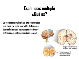 Esclerosis múltiple
¿Qué es?
La esclerosis múltiple es una enfermedad
que consiste en la aparición de lesiones
desmielinizantes, neurodegenerativas y
crónicas del sistema nervioso central.
 
