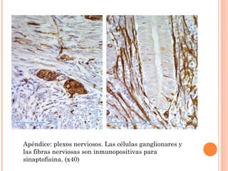 Apéndice: plexos nerviosos. Las células ganglionares y
las fibras nerviosas son inmunopositivas para
sinaptofisina. (x40)
 