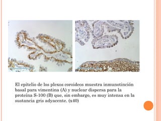 El epitelio de los plexos coroideos muestra inmunotinción
basal para vimentina (A) y nuclear dispersa para la
proteína S-100 (B) que, sin embargo, es muy intensa en la
sustancia gris adyacente. (x40)
 
