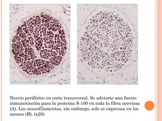 Nervio periférico en corte transversal. Se advierte una fuerte
inmunotinción para la proteína S-100 en toda la fibra nerviosa
(A). Los neurofilamentos, sin embargo, solo se expresan en los
axones (B). (x20)
 