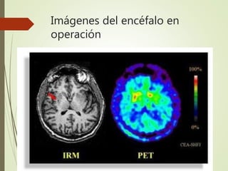 Imágenes del encéfalo en
operación
 