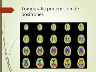 Tomografía por emisión de
positrones
 
