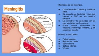 Meningitis
Inflamación de las meninges.
★ Ocurre entre los 3 meses y 2 años de
edad.
★ Es causada por bacterias y virus que
invaden el SNC por vía nasal o
faríngea.
★ La piamadre y la aracnoides son las
más afectadas con frecuencia.
★ Puede causar inflamación del
encéfalo, hemorragia cerebral, y en
ocasiones muerte.
SIGNOS Y SÍNTOMAS
★ Fiebre elevada.
★ Rigidez del cuello.
★ Somnolencia.
★ Cefalea intensa.
★ Vómito.
 