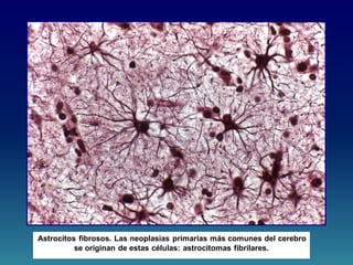 Astrocitos fibrosos. Las neoplasias primarias más comunes del cerebro
se originan de estas células: astrocitomas fibrilares.
 