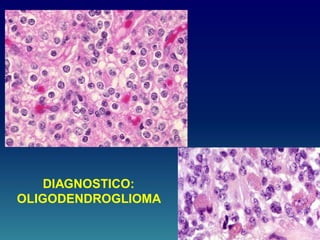 DIAGNOSTICO:
OLIGODENDROGLIOMA
 