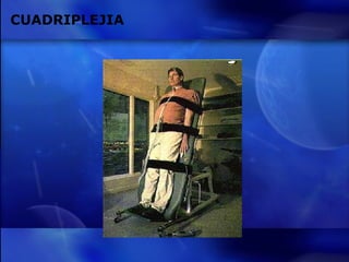 CUADRIPLEJIA 