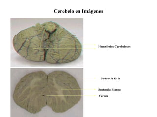 Cerebelo en Imágenes
Vérmix
Sustancia Blanca
Sustancia Gris
Hemisferios Cerebelosos
 