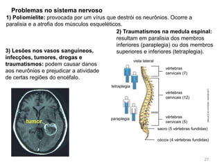 Problemas no sistema nervoso
2) Traumatismos na medula espinal:
resultam em paralisia dos membros
inferiores (paraplegia) ou dos membros
superiores e inferiores (tetraplegia).
3) Lesões nos vasos sanguíneos,
infecções, tumores, drogas e
traumatismos: podem causar danos
aos neurônios e prejudicar a atividade
de certas regiões do encéfalo.
1) Poliomielite: provocada por um vírus que destrói os neurônios. Ocorre a
paralisia e a atrofia dos músculos esqueléticos.
LUÍS
MOURA
/
ARQUIVO
DA
EDITORA
tetraplegia
paraplegia
vista lateral
vértebras
cervicais (7)
vértebras
cervicais (12)
vértebras
cervicais (5)
sacro (5 vértebras fundidas)
cóccix (4 vértebras fundidas)
27
 