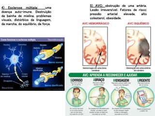 28
4) Esclerose múltipla: uma
doença auto-imune. Destruição
da bainha de mielina. problemas
visuais, distúrbios da linguagem,
da marcha, do equilíbrio, da força.
5) AVC: obstrução de uma artéria.
Lesão irreversível. Fatores de risco:
pressão arterial elevada, alto
colesterol, obesidade.
 