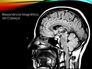 Ressonância Magnética
da Cabeça
 