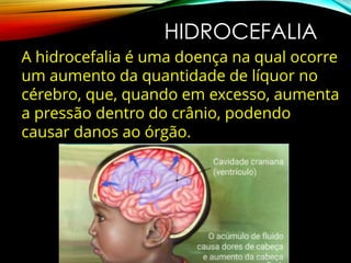 HIDROCEFALIA
A hidrocefalia é uma doença na qual ocorre
um aumento da quantidade de líquor no
cérebro, que, quando em excesso, aumenta
a pressão dentro do crânio, podendo
causar danos ao órgão.
 