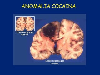 ANOMALIA COCAINA
 